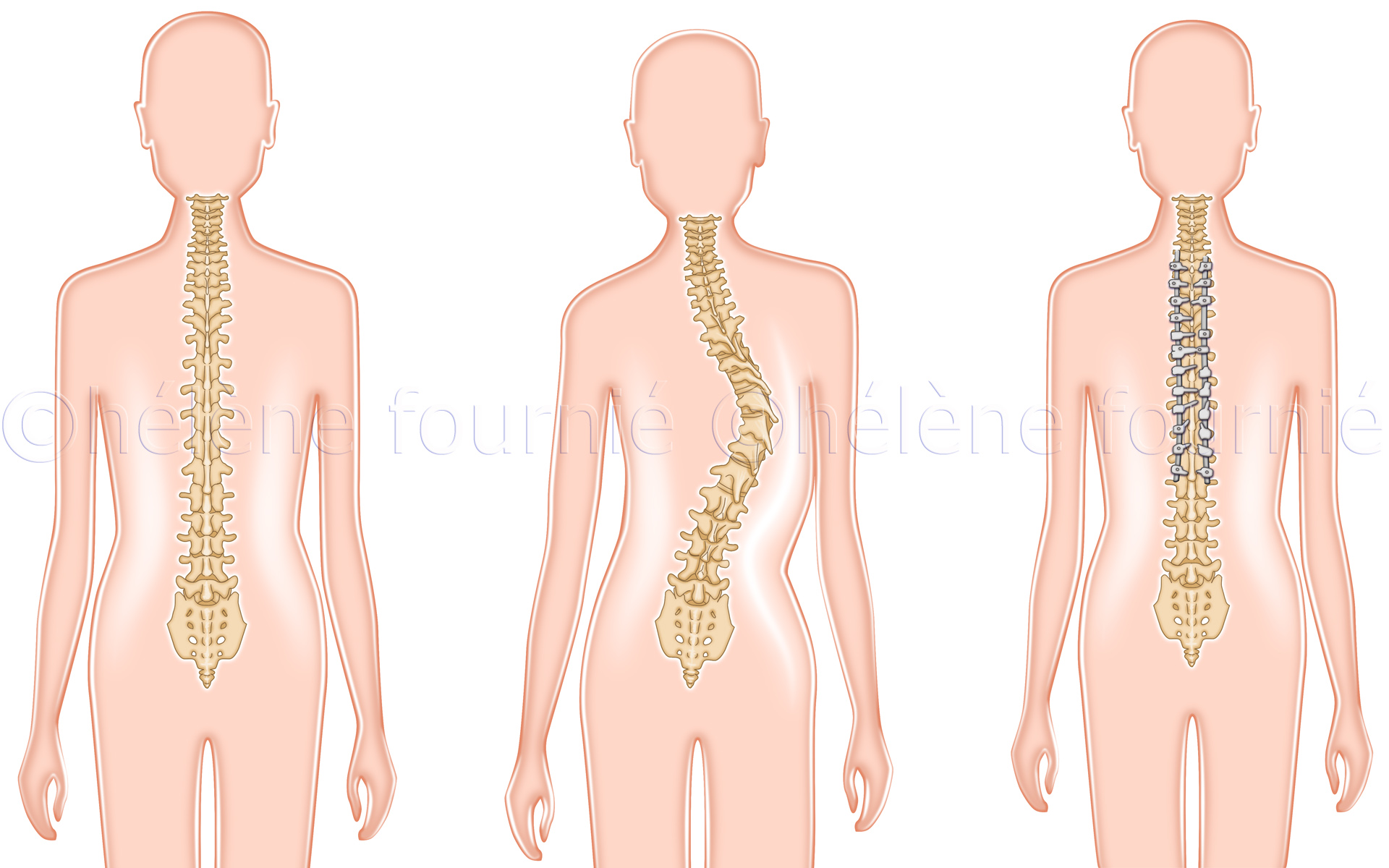 Spinal-surgery-scoliosis