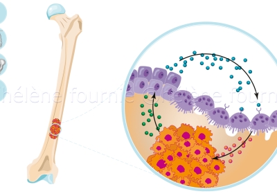 Metastases du cancer du rein