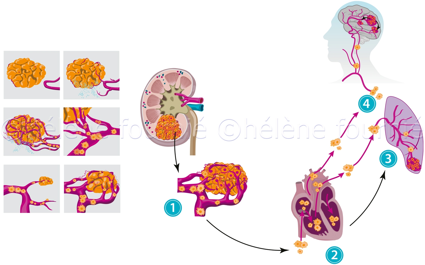 Practical Guide Kidney Cancer Metastases